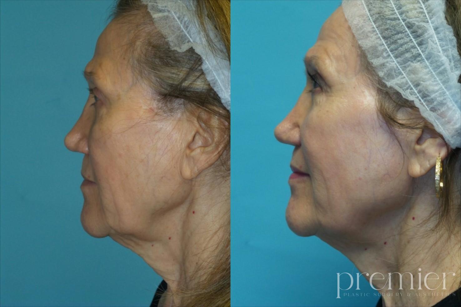 Face Neck4