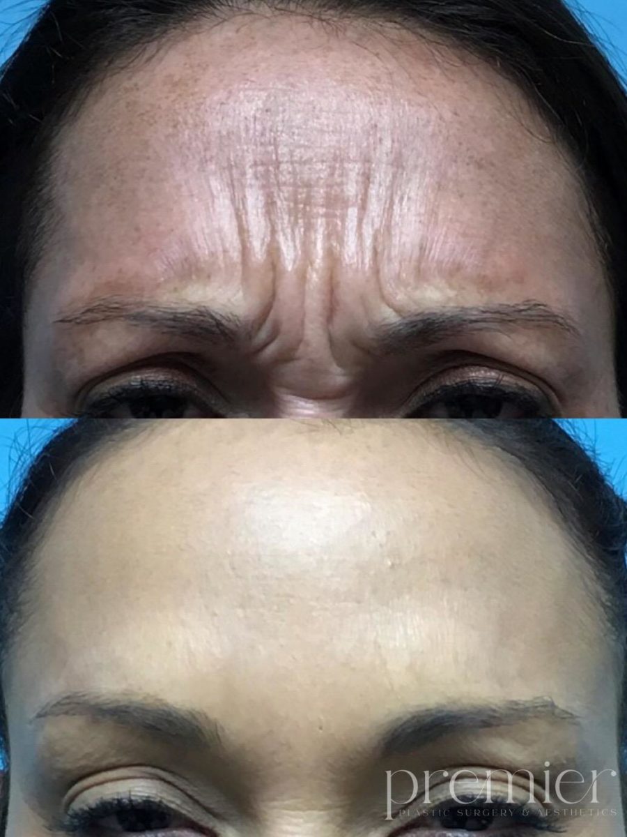 Forehead Glabella 900x1200