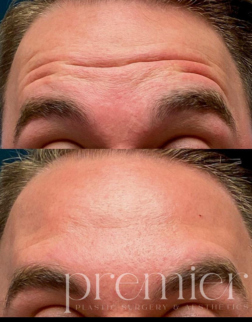 Forehead