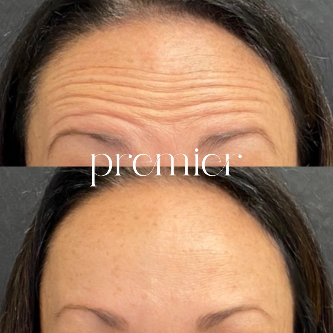 Forehead1