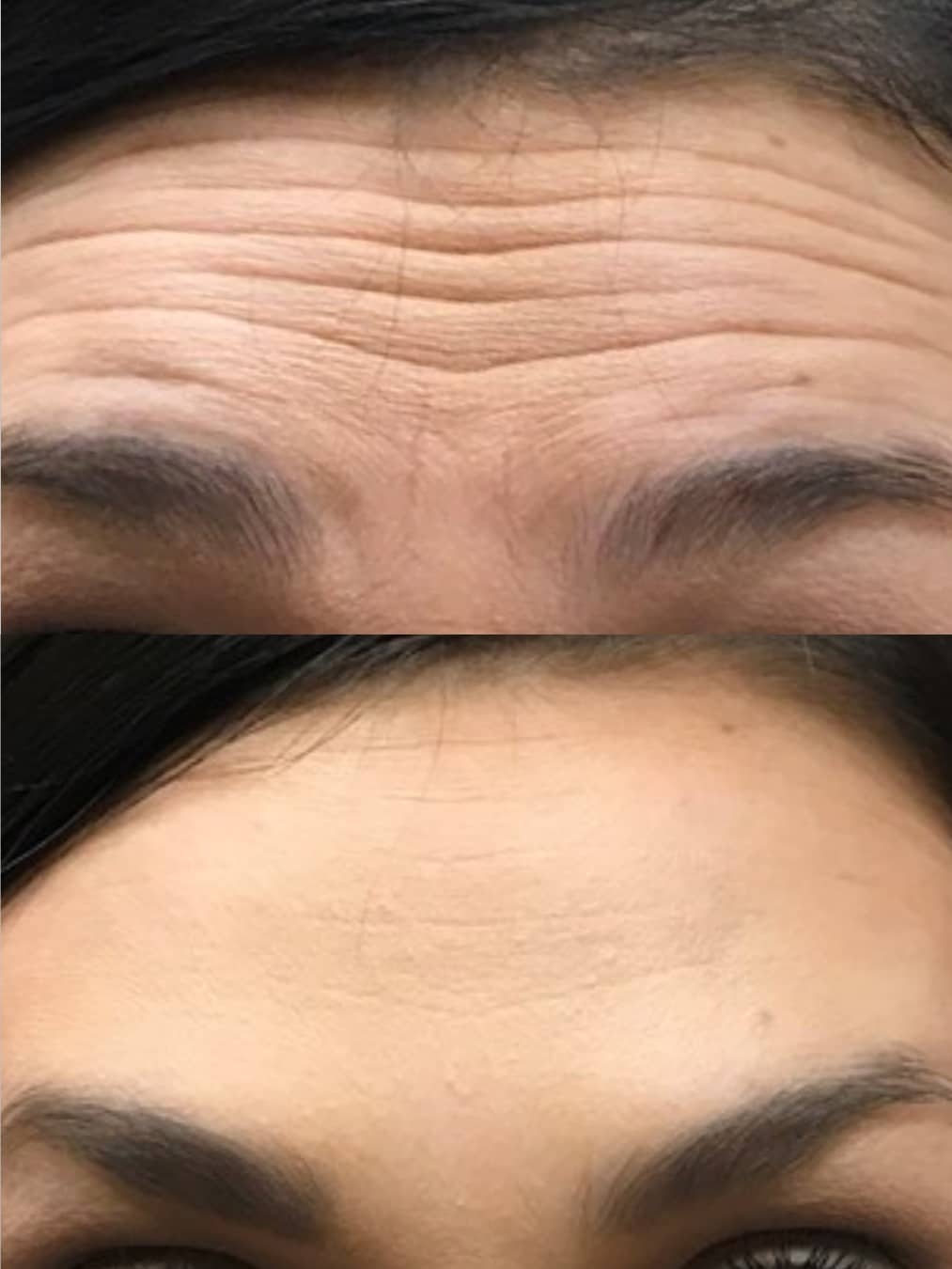 Forehead2