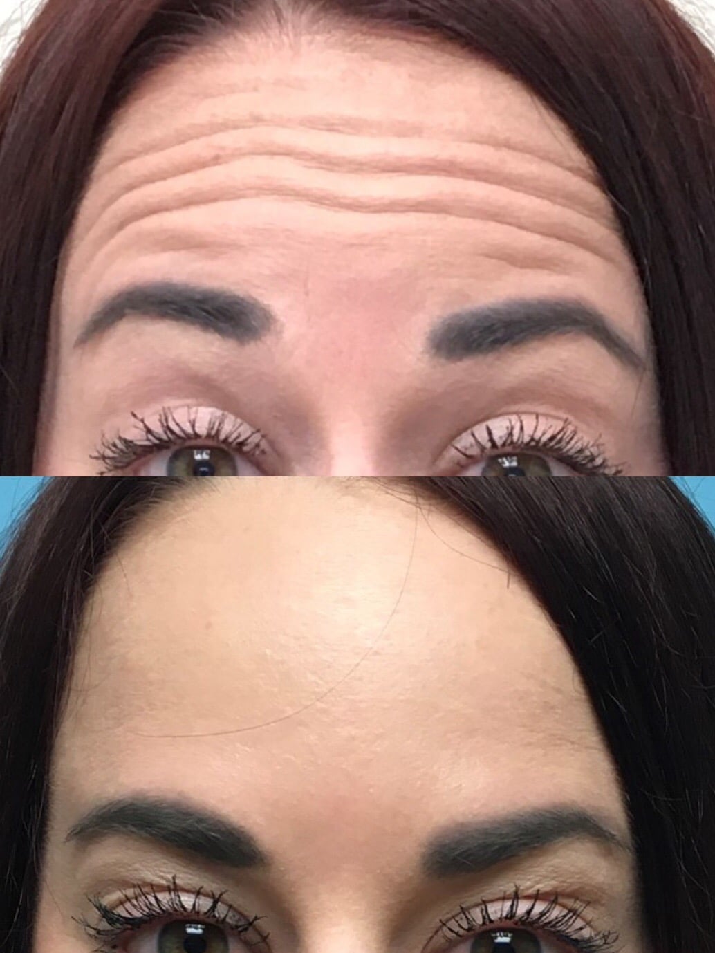 Forehead3