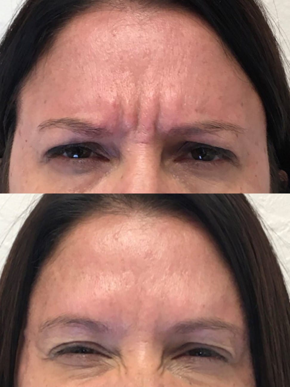 Glabella