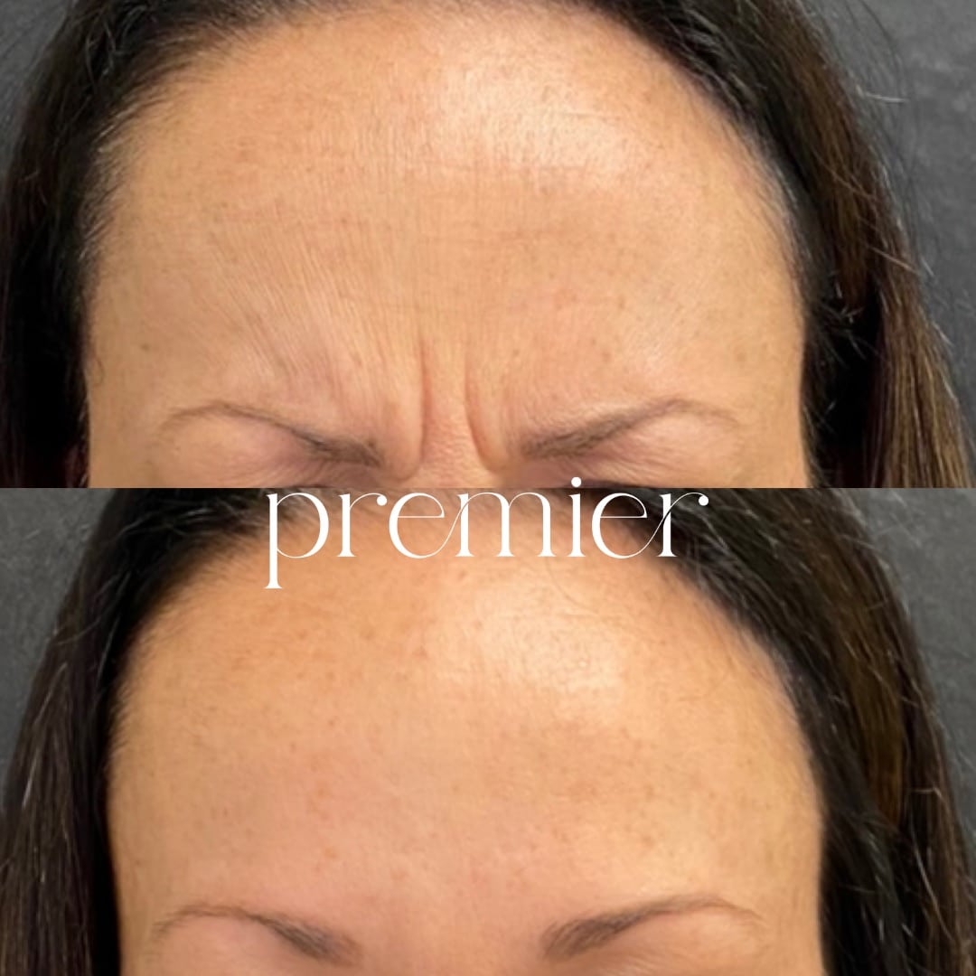Glabella1