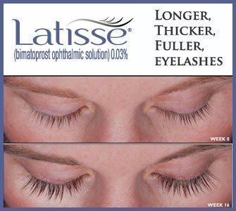 Latisse before After latissecoupon.com