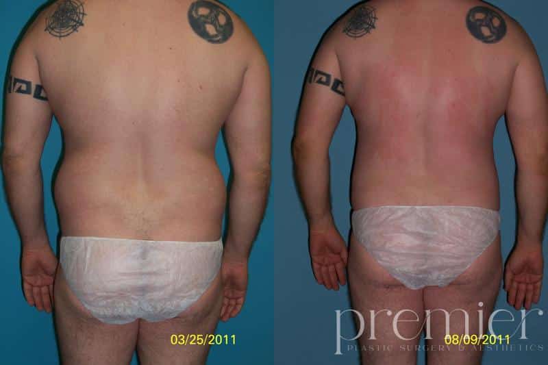 Liposuction 032511 pre7