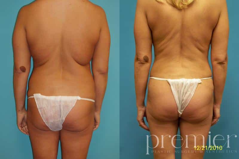Liposuction 061110 pre04