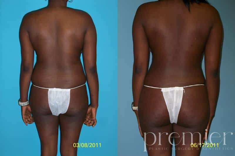Liposuction 061711 post4