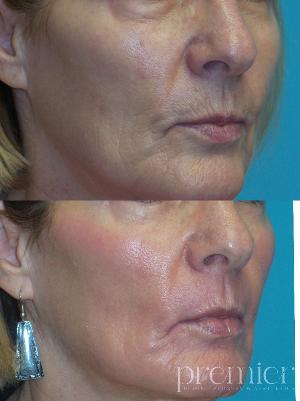 Lower Face