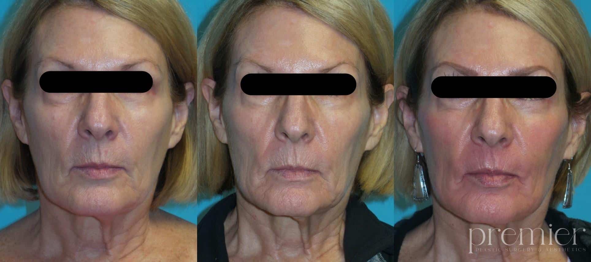 Lower Face1