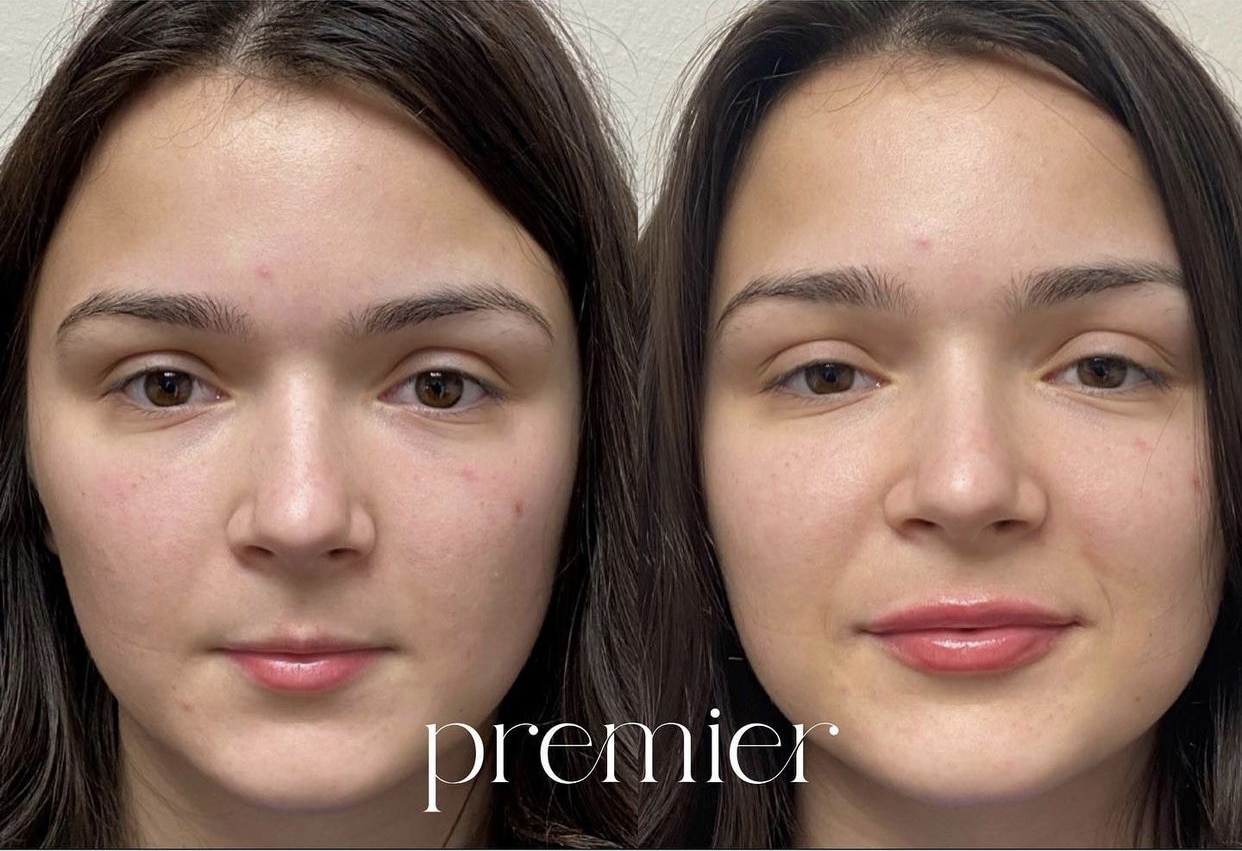Restylane Kysse1