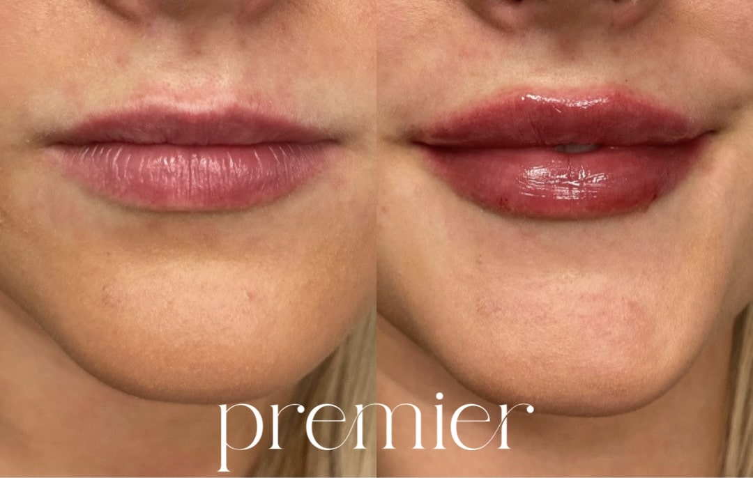 Restylane Kysse2