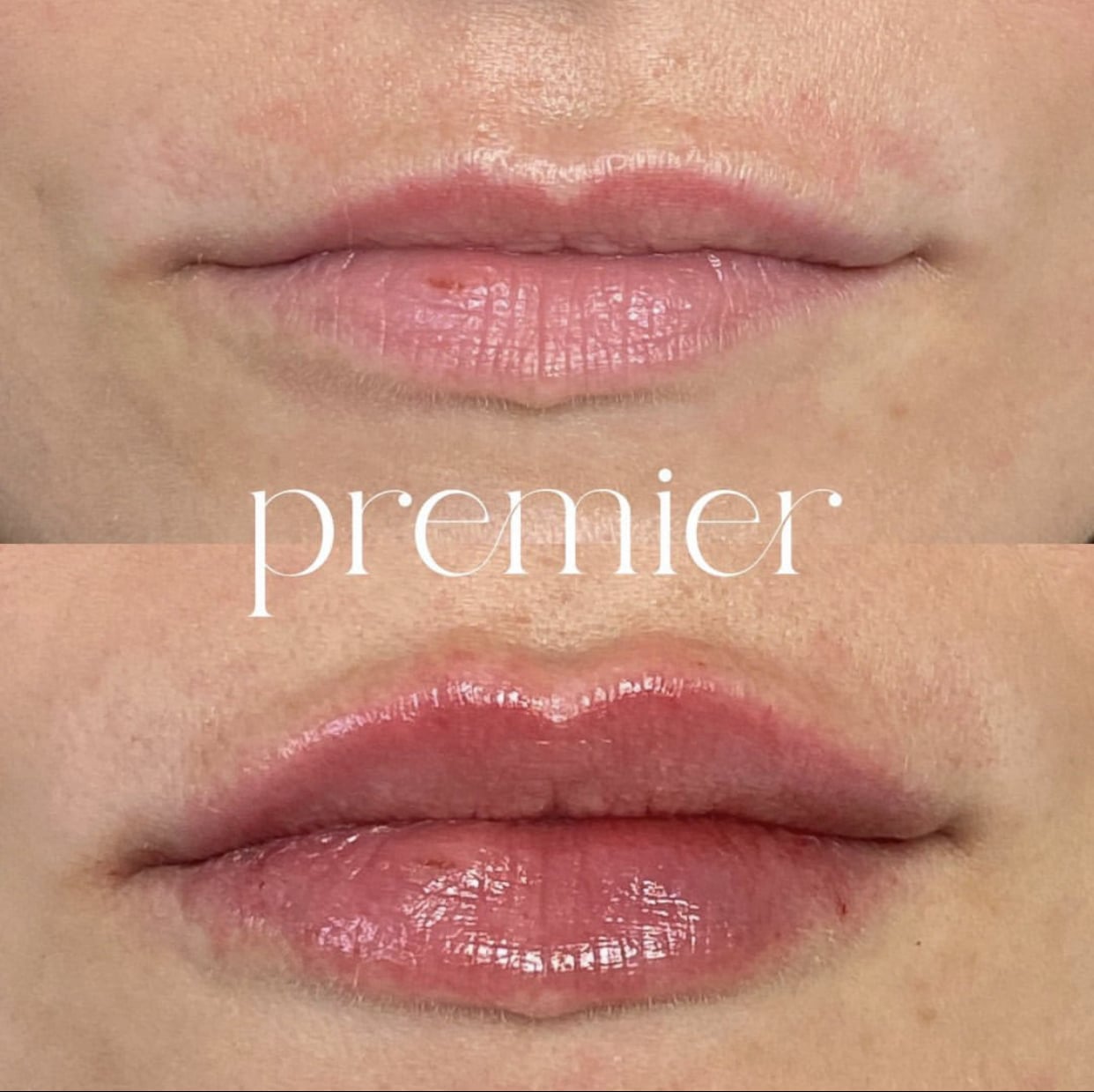 Revanesse Lips (1)