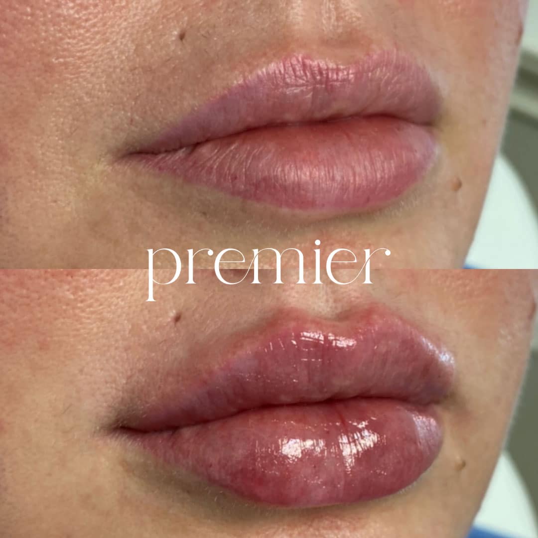 Revanesse Lips