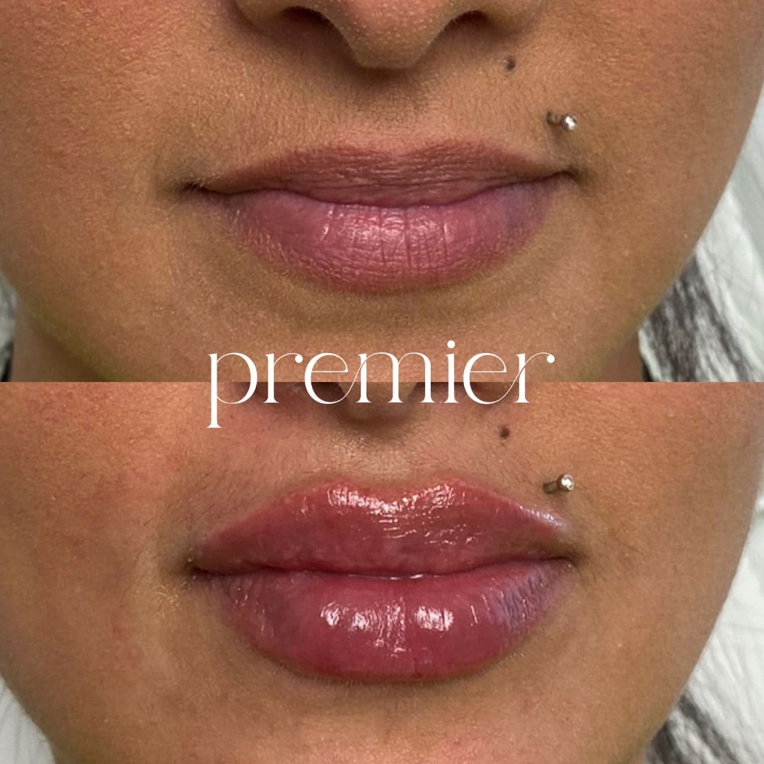 Revanesse Lips1