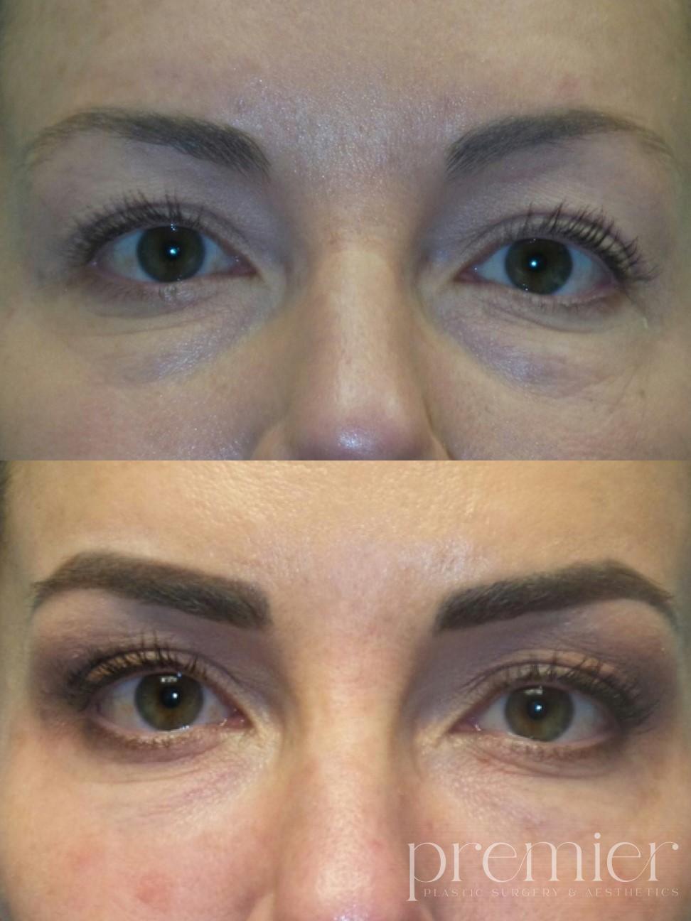 Tear Troughs