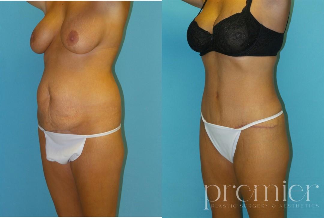 Tummy Tuck
