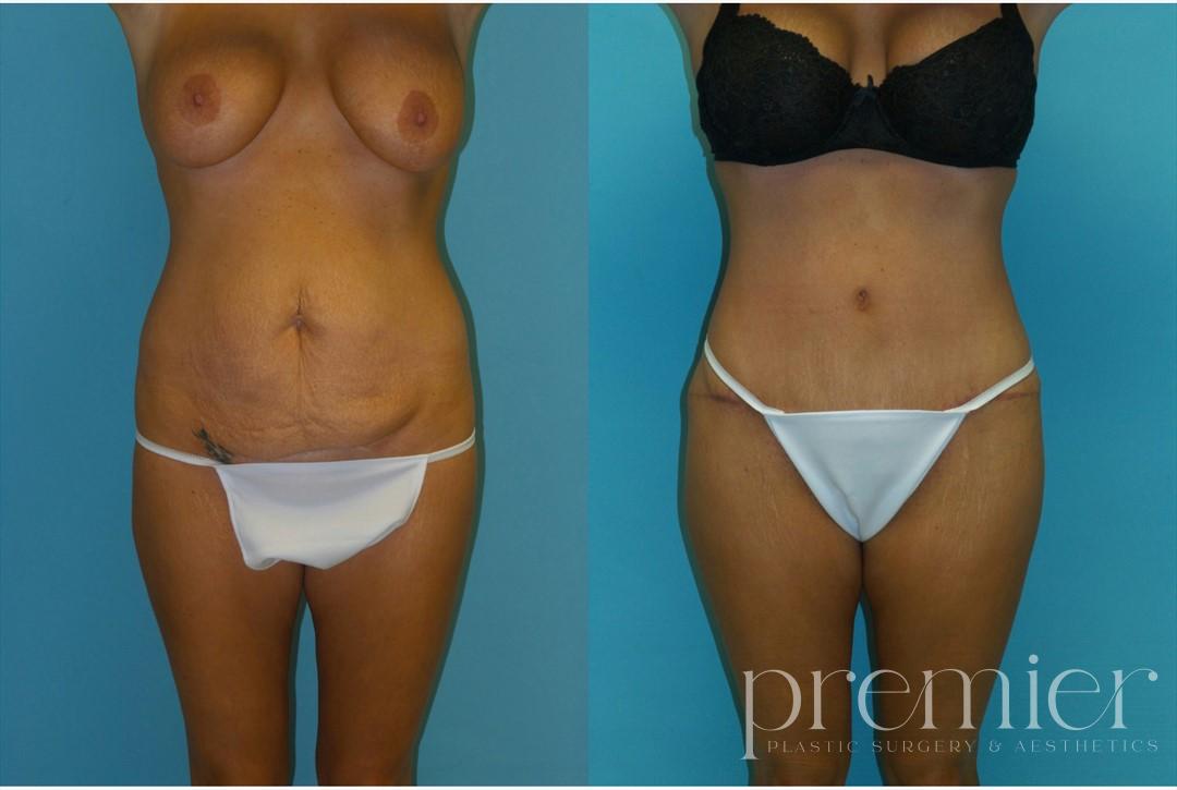 Tummy Tuck1