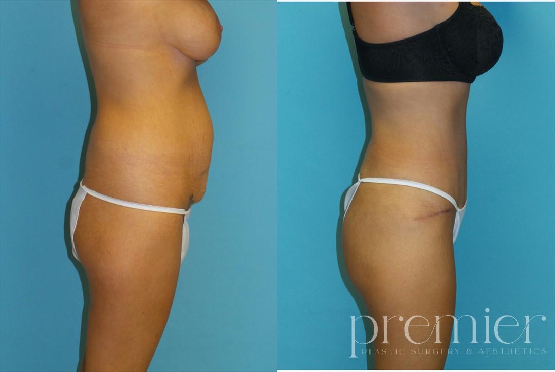 Tummy Tuck2