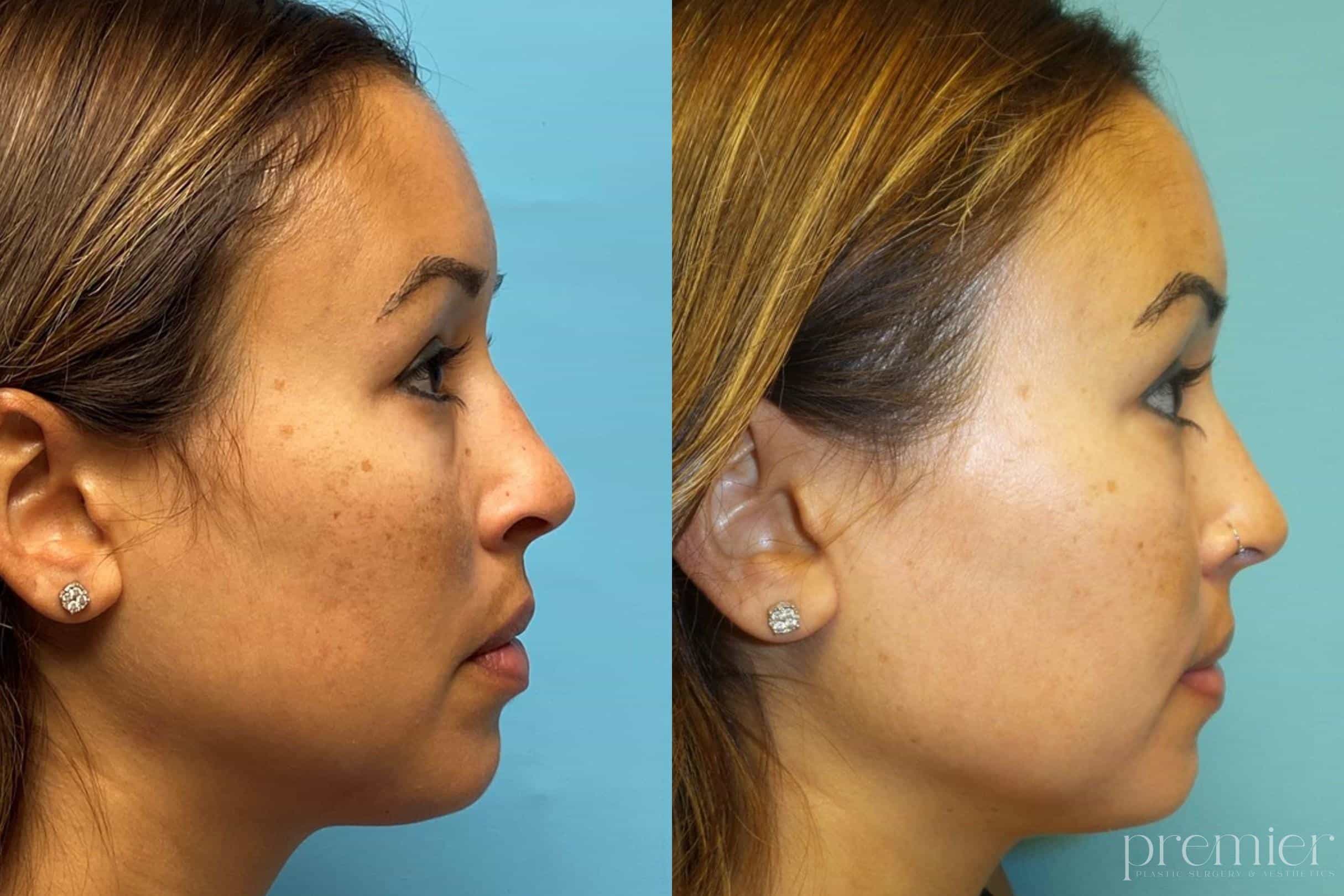 ZO 3 Step Peel 2