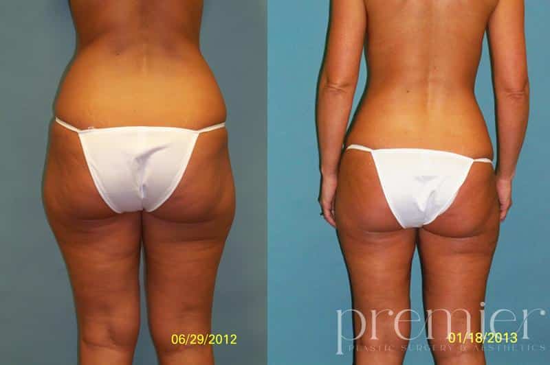lipo fat grafting okc 062912 pre0 2