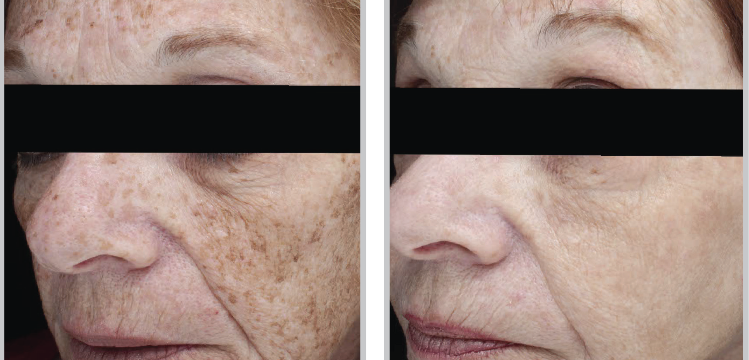 Before and After Image: BBL (Broadband Light) - left-front-oblique