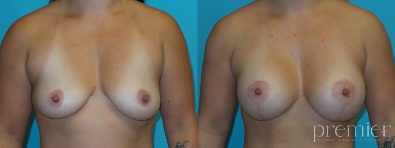 Before and After Image: Breast Lift - front