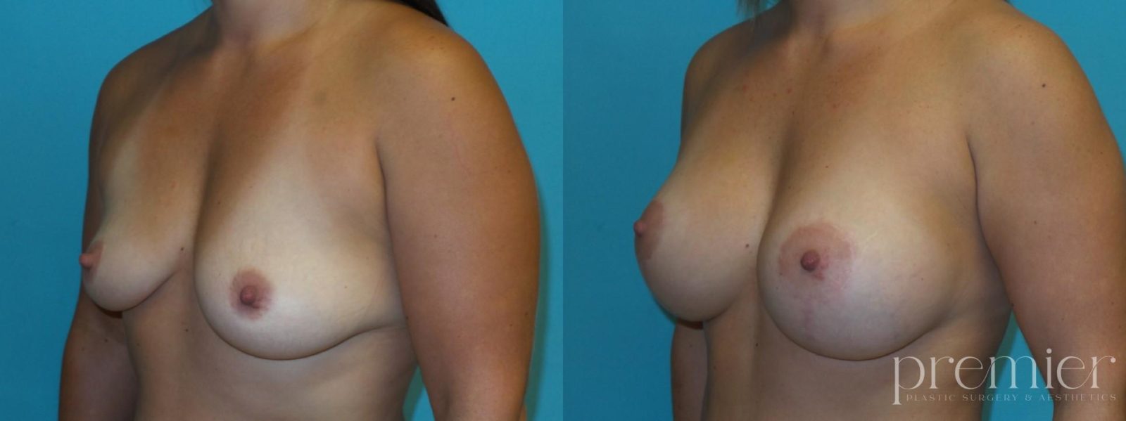 Before and After Image: Breast Lift - left-front-oblique