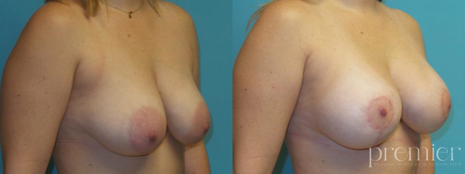 Before and After Image: Breast Lift - right-front-oblique
