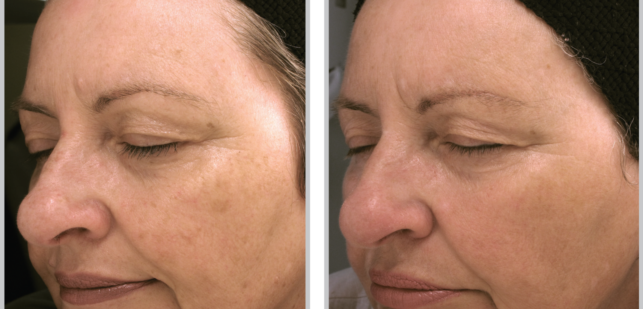 Before and After Image: BBL (Broadband Light) - left-front-oblique