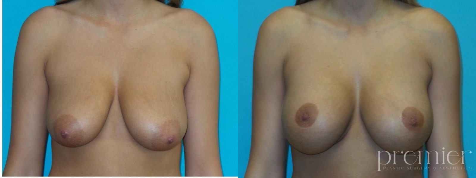 Before and After Image: Breast Augmentation with Lift - front