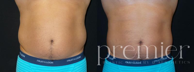 Before and After Image: CoolSculpting - front