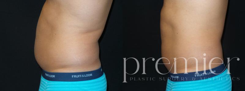 Before and After Image: CoolSculpting - left-side