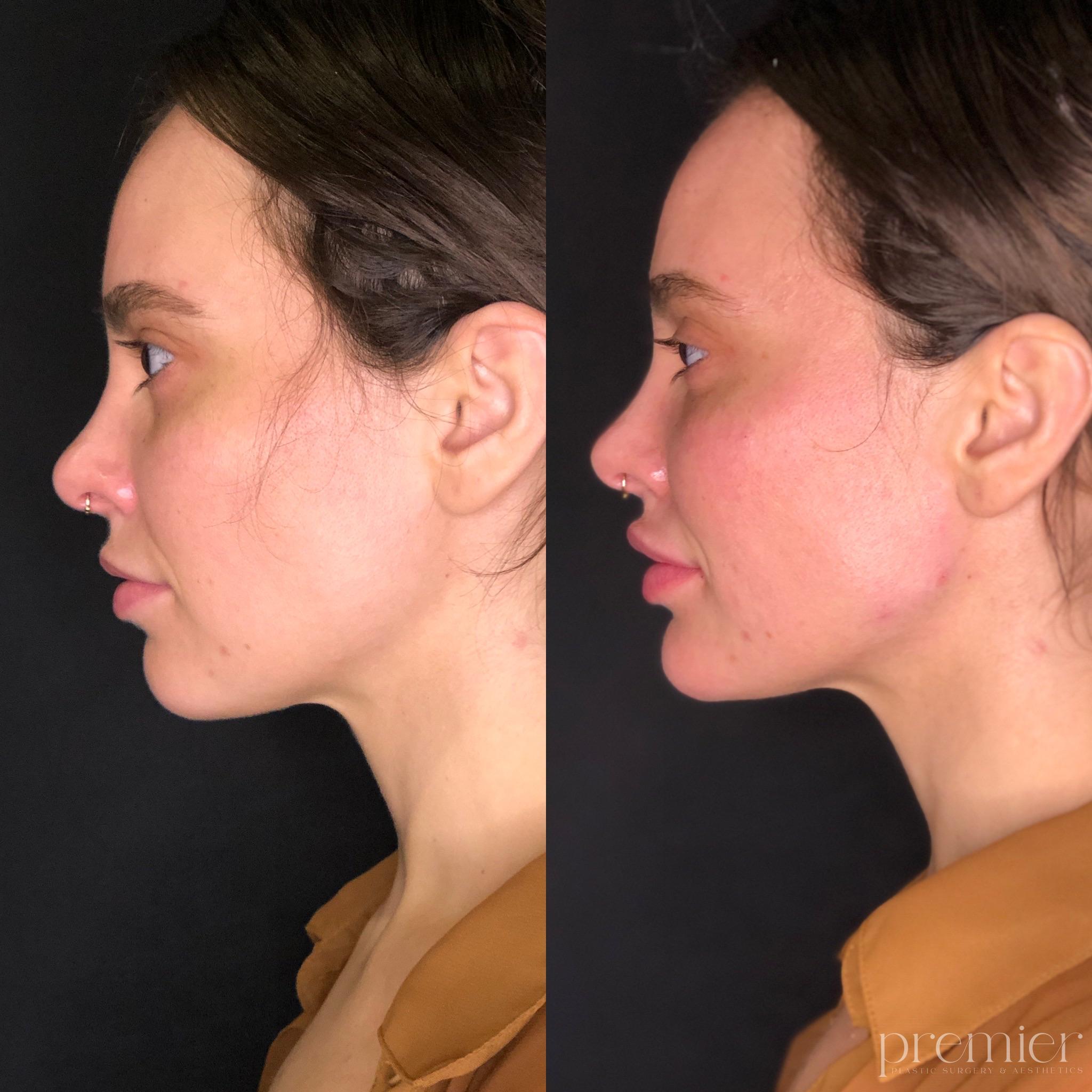 Before and After Image: Dermal Fillers - left-side