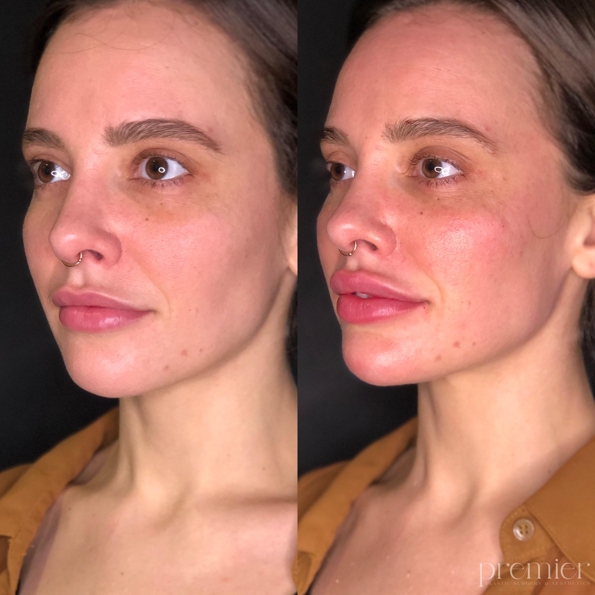Before and After Image: Dermal Fillers - left-front-oblique