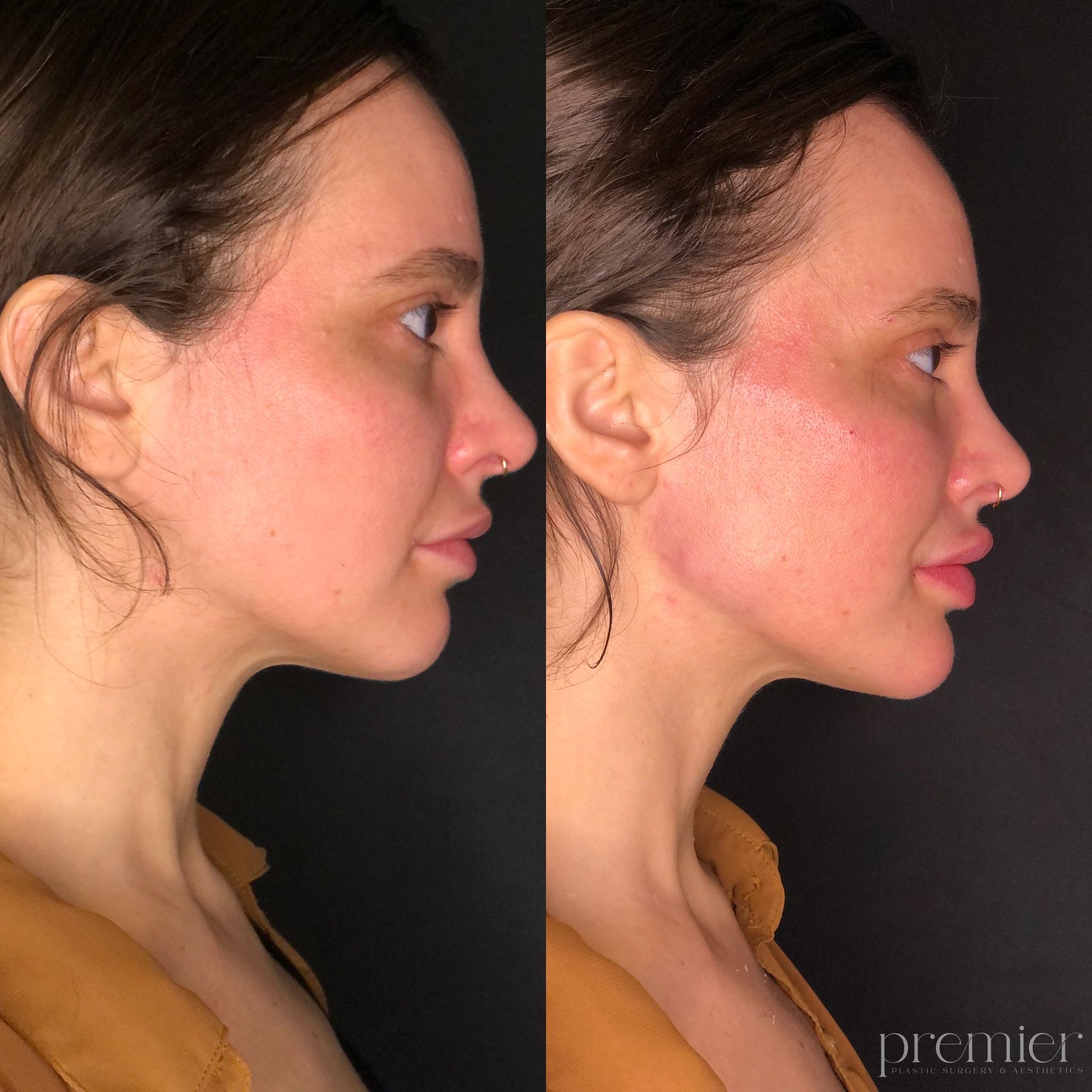 Before and After Image: Dermal Fillers - right-side