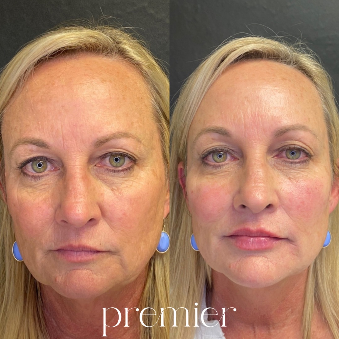 Before and After Image: Dermal Fillers - front