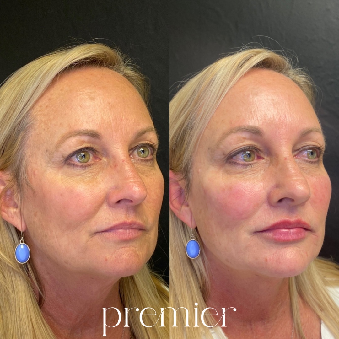 Before and After Image: Dermal Fillers - right-front-oblique
