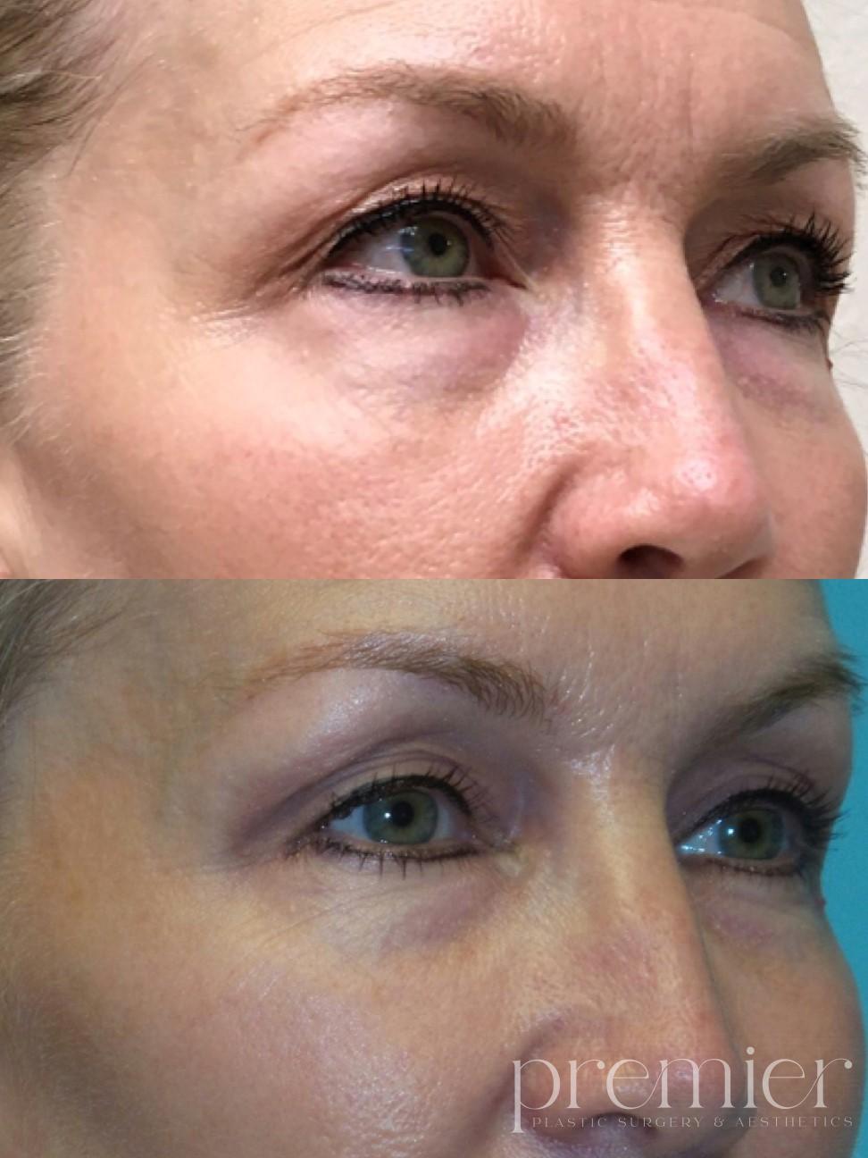 Before and After Image: Dermal Fillers - right-front-oblique
