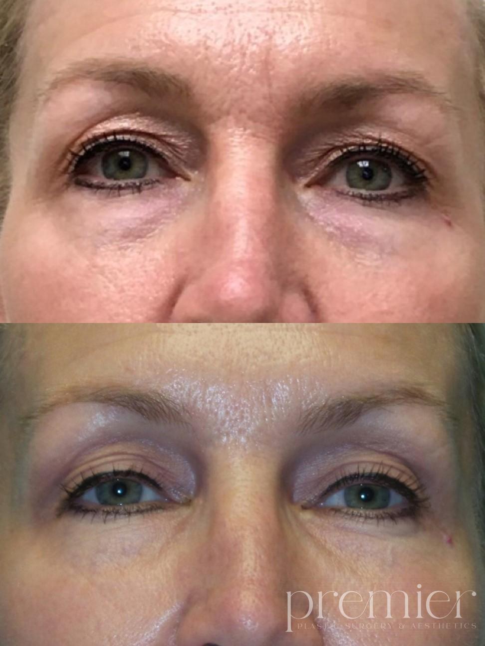 Before and After Image: Dermal Fillers - front