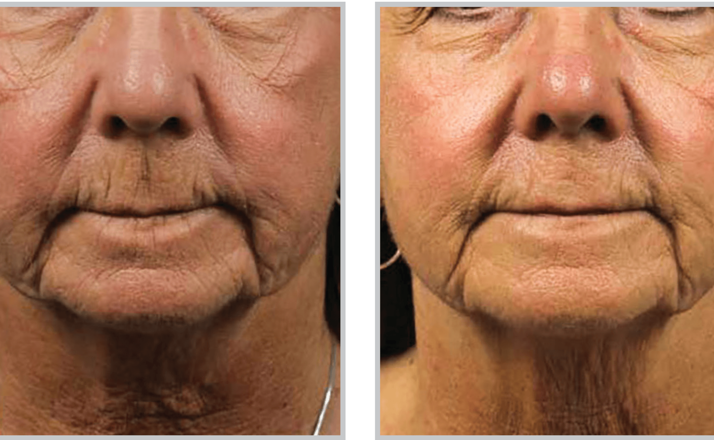 Before and After Image: HALO - front