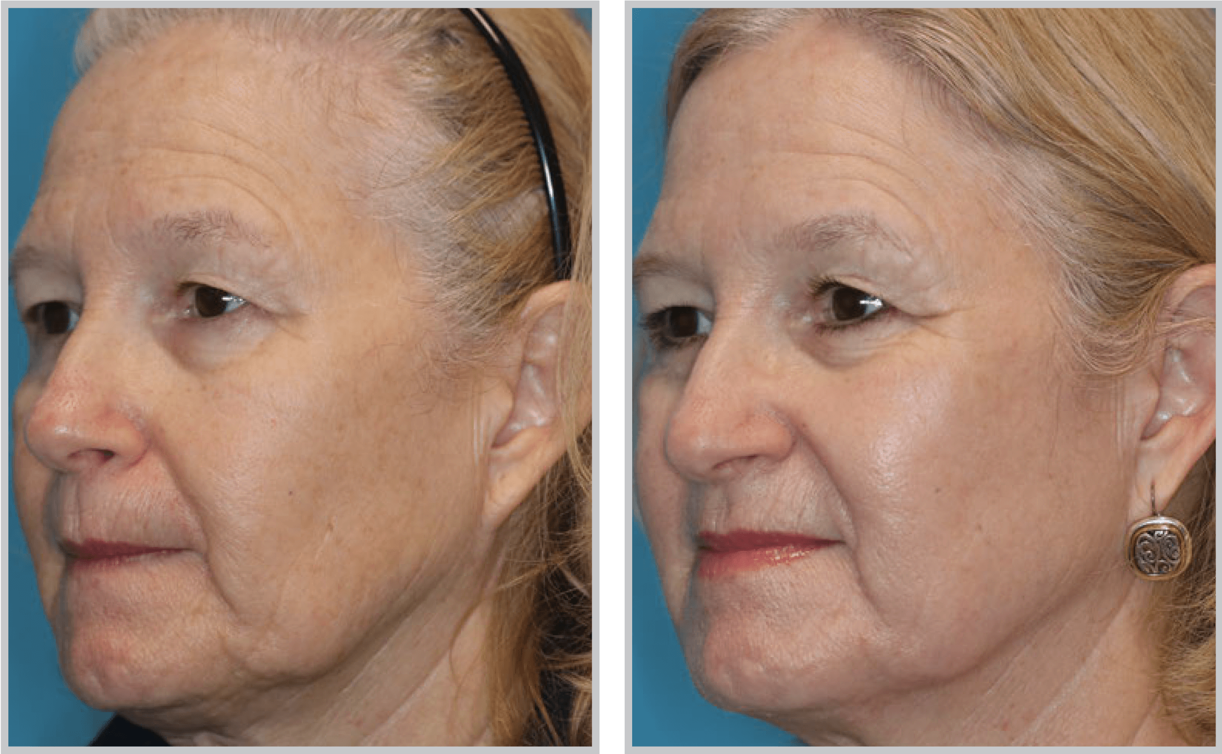 Before and After Image: HALO - left-front-oblique