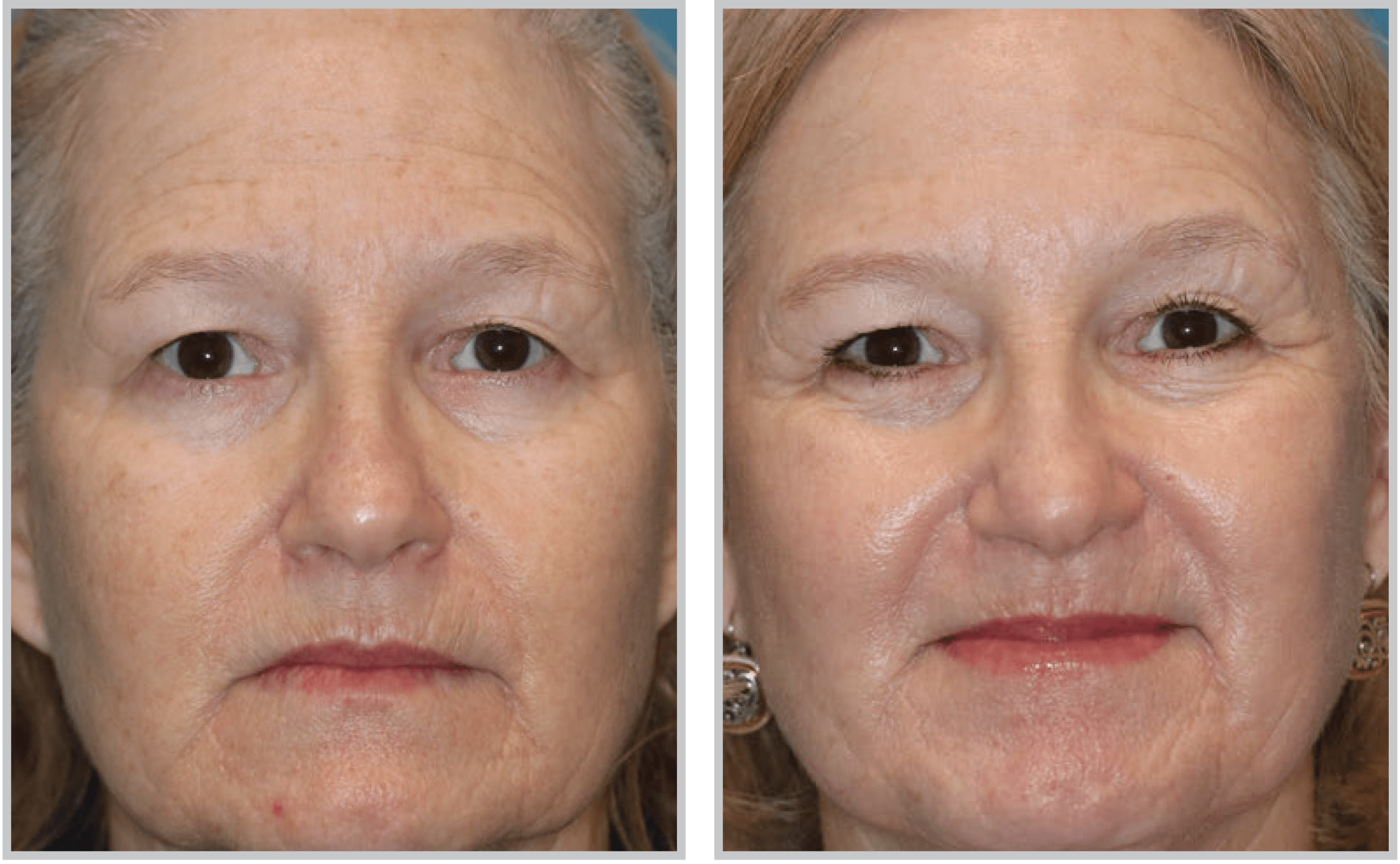 Before and After Image: HALO - front