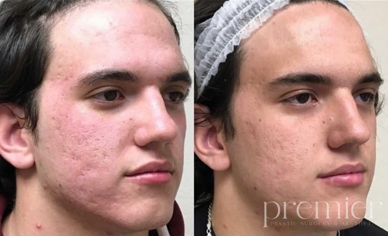Before and After Image: Microneedling - right-front-oblique