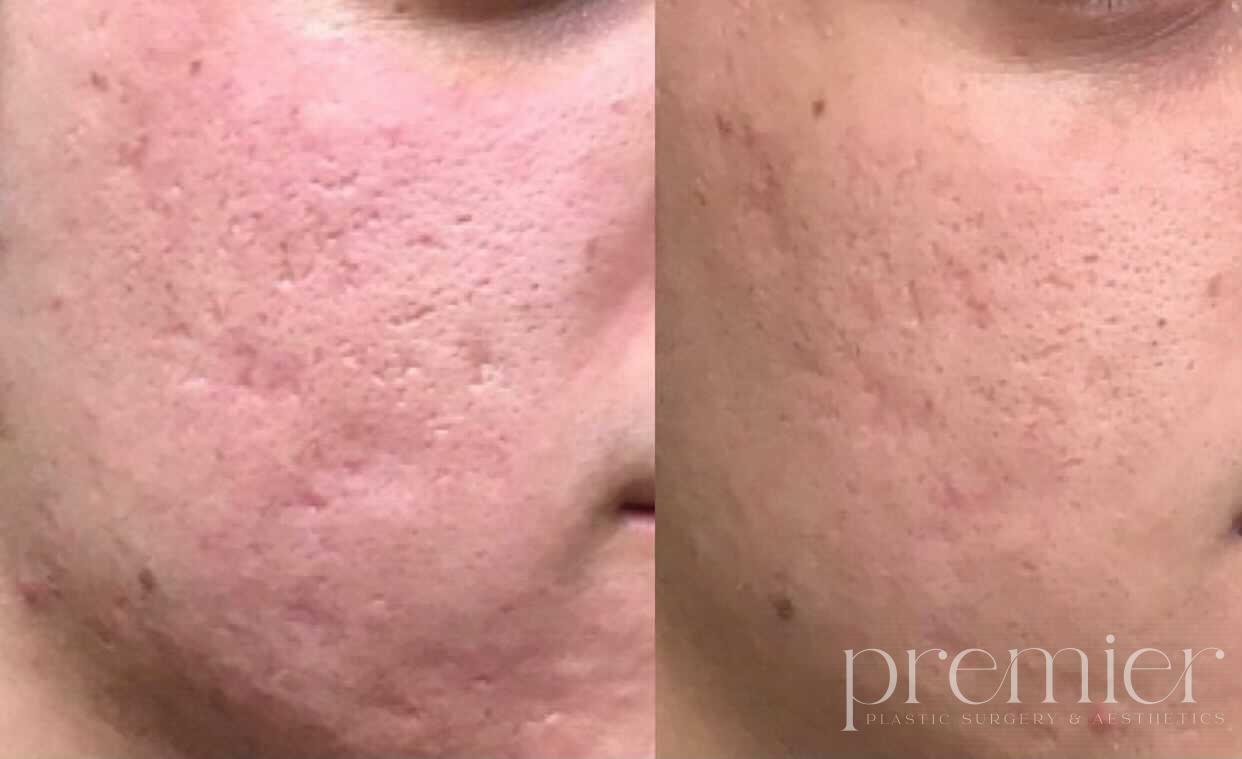 Before and After Image: Microneedling - right-front-oblique