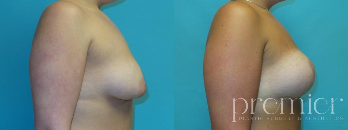 Before and After Image: Breast Augmentation with Lift - left-side