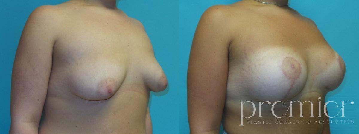 Before and After Image: Breast Augmentation with Lift - right-front-oblique