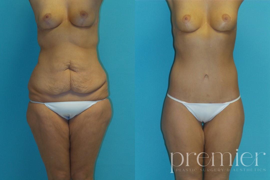 Before and After Image: Tummy Tuck - front