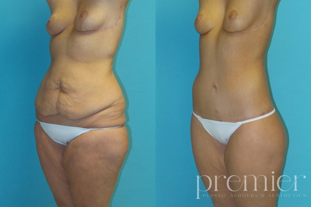 Before and After Image: Tummy Tuck - left-front-oblique