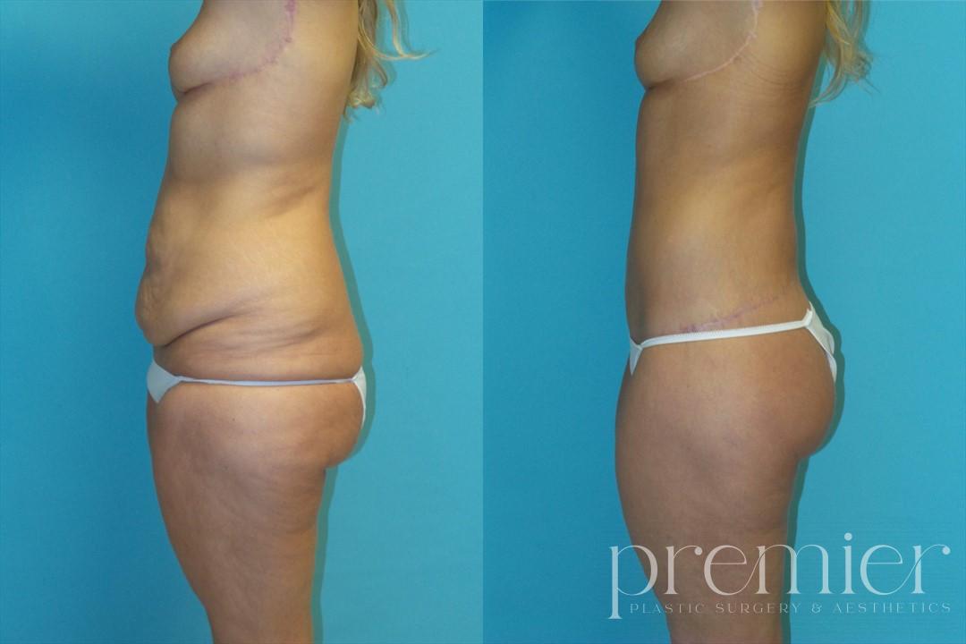 Before and After Image: Tummy Tuck - left-side